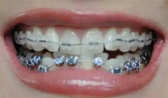   لماذا نهى النبي عن تفلج  المرأة على زوجها في غرفه النوم،،  وما عقوبة المتفلج  ؟ وما معنى التفليج ؟