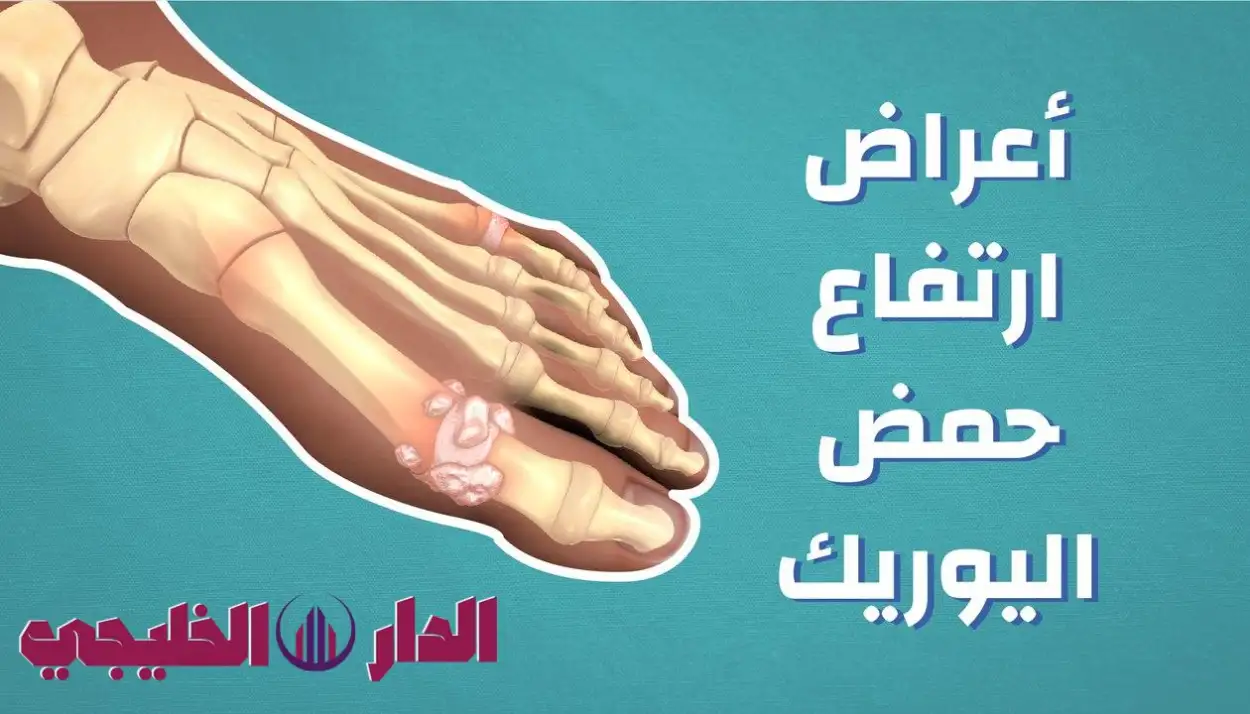     5 إشارات إنذار مبكر يرسلها جسمك عند ارتفاع حمض اليوريك - لا تتجا 