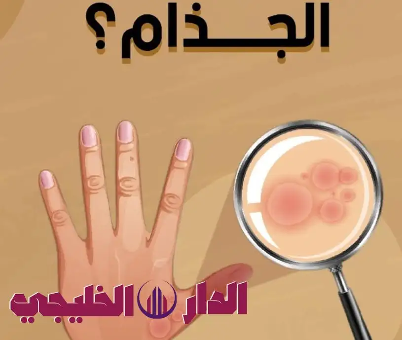     تعرف على مرض الجذام.. وطرق الوقاية عدوى الجذام 