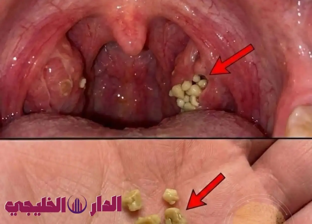     الحصوات البيضاء 