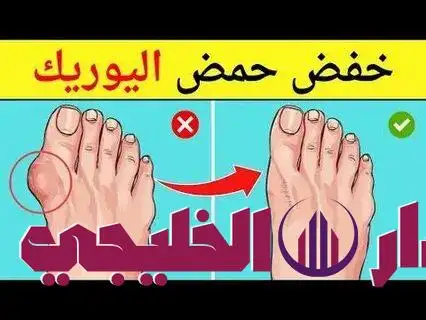     حمض اليوريك  