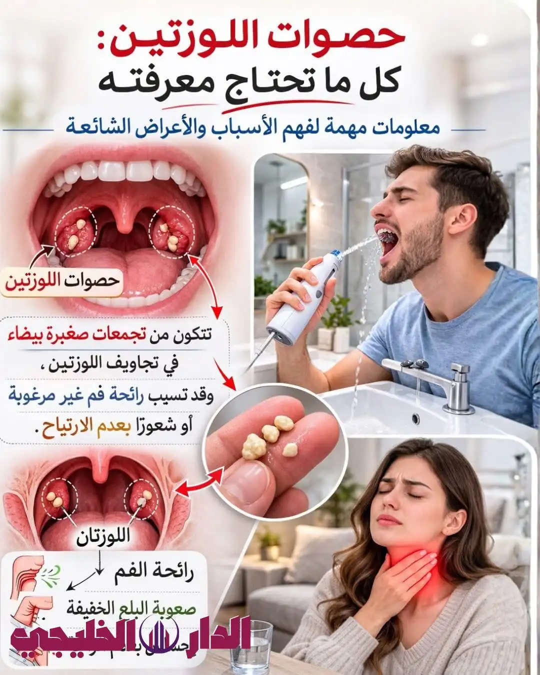     حصى اللوزتين 